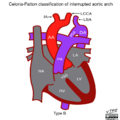 Celoria-Patton classification of interrupted aortic arch (illustration) (Radiopaedia 51881-57708 C 1).png