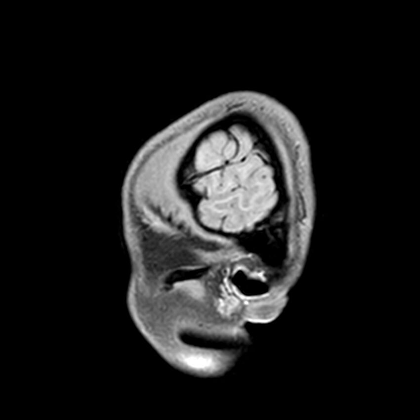 Central neurocytoma (Radiopaedia 79320-92380 Sagittal T1 25).jpg