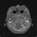 Cerebellar abscess secondary to mastoiditis (Radiopaedia 26284-26413 Axial bone window 30).jpg