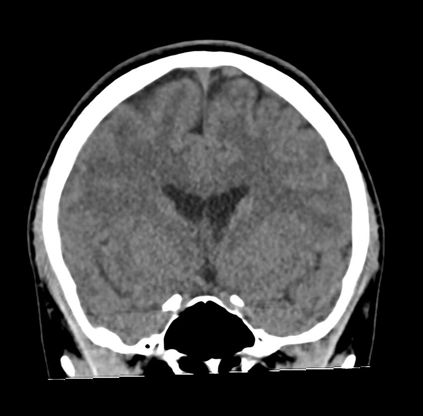 Cerebellar agenesis (Radiopaedia 30203-30817 Coronal non-contrast 12).jpg