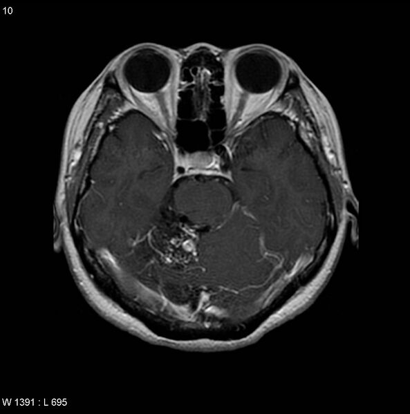 File:Cerebellar arteriovenous malformation (Radiopaedia 5220-6988 Axial T1 C+ 1).jpg