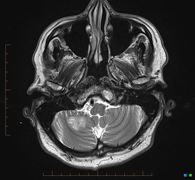 File:Cerebellar gangliocytoma (Radiopaedia 65377-74422 Axial T2 5).jpg
