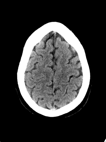 File:Cerebellar infarct due to vertebral artery dissection with posterior fossa decompression (Radiopaedia 82779-97032 Axial non-contrast 25).png