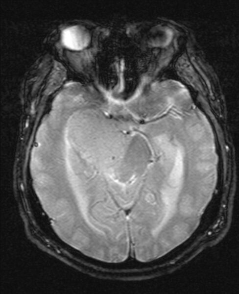 File:Cerebellopontine angle meningioma (Radiopaedia 24459-24764 Axial Gradient Echo 9).jpg