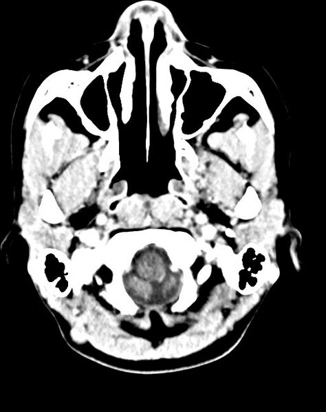 File:Cerebral abscesses (Radiopaedia 70458-80568 Axial Contrast 11).jpg