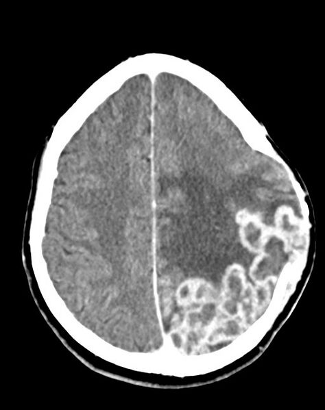 File:Cerebral abscesses (Radiopaedia 70458-80568 Axial Contrast 44).jpg