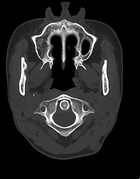 File:Cerebral abscesses (Radiopaedia 70458-80568 Axial bone window 7).jpg