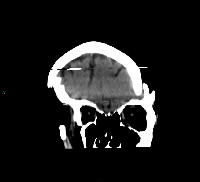 File:Cerebral amyloid angiopathy-associated lobar intracerebral hemorrhage (Radiopaedia 58377-65514 Coronal non-contrast 52).jpg
