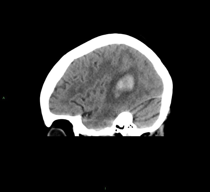 Cerebral amyloid angiopathy-associated lobar intracerebral hemorrhage (Radiopaedia 58378-65516 C 14).jpg