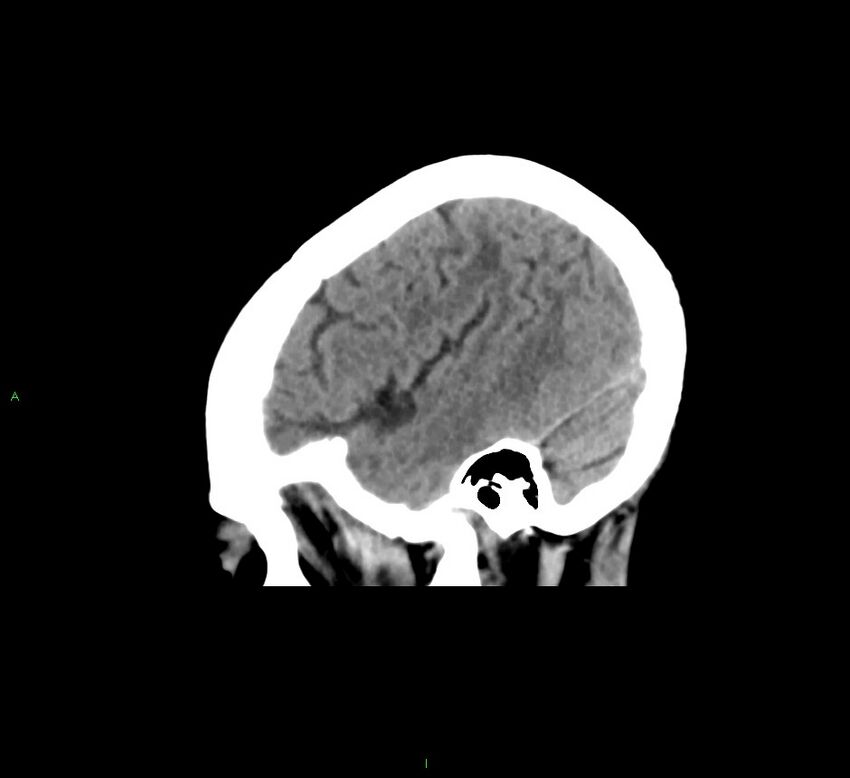 Cerebral amyloid angiopathy-associated lobar intracerebral hemorrhage (Radiopaedia 58378-65516 C 41).jpg