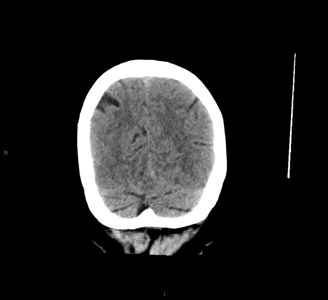 File:Cerebral amyloid angiopathy-associated lobar intracerebral hemorrhage (Radiopaedia 58529-65681 Coronal non-contrast 14).jpg