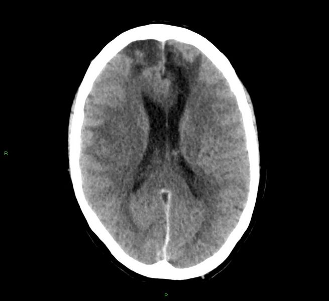 File:Cerebral amyloid angiopathy-associated lobar intracerebral hemorrhage (Radiopaedia 58529-65687 Axial non-contrast 24).jpg