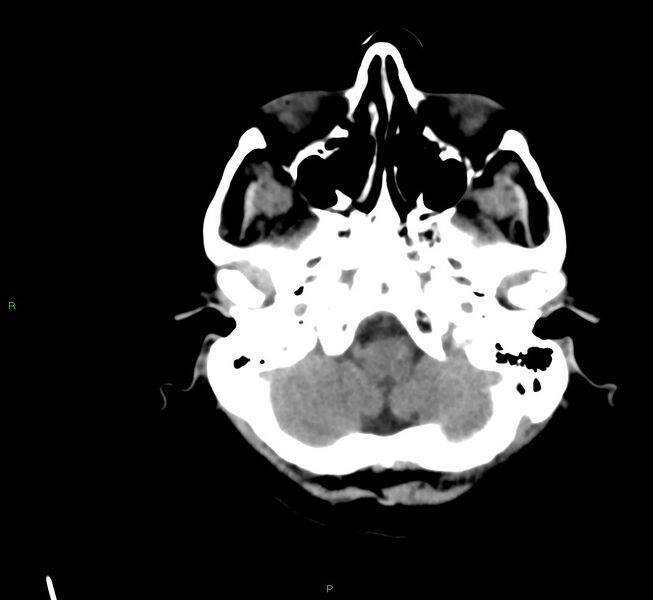 File:Cerebral amyloid angiopathy-associated lobar intracerebral hemorrhage (Radiopaedia 58561-65724 Axial non-contrast 40).jpg