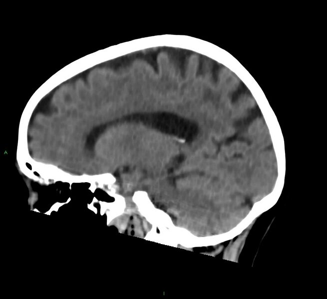File:Cerebral amyloid angiopathy-associated lobar intracerebral hemorrhage (Radiopaedia 58757-65978 C 23).jpg