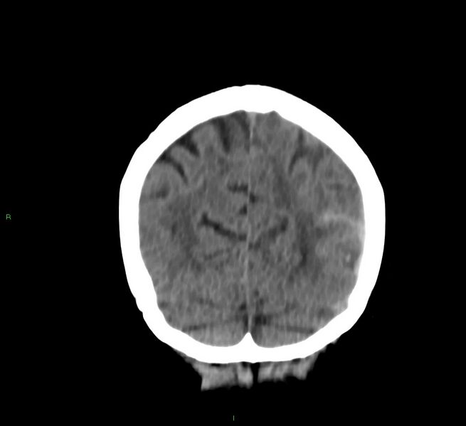 File:Cerebral amyloid angiopathy-associated lobar intracerebral hemorrhage (Radiopaedia 58757-65978 Coronal non-contrast 17).jpg