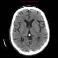 Cerebral and orbital tuberculomas (Radiopaedia 13308-13310 Axial non-contrast 33).jpg