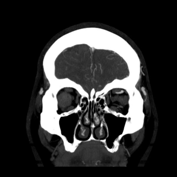 File:Cerebral arteriovenous malformation (Radiopaedia 43729-47189 C 7).jpg