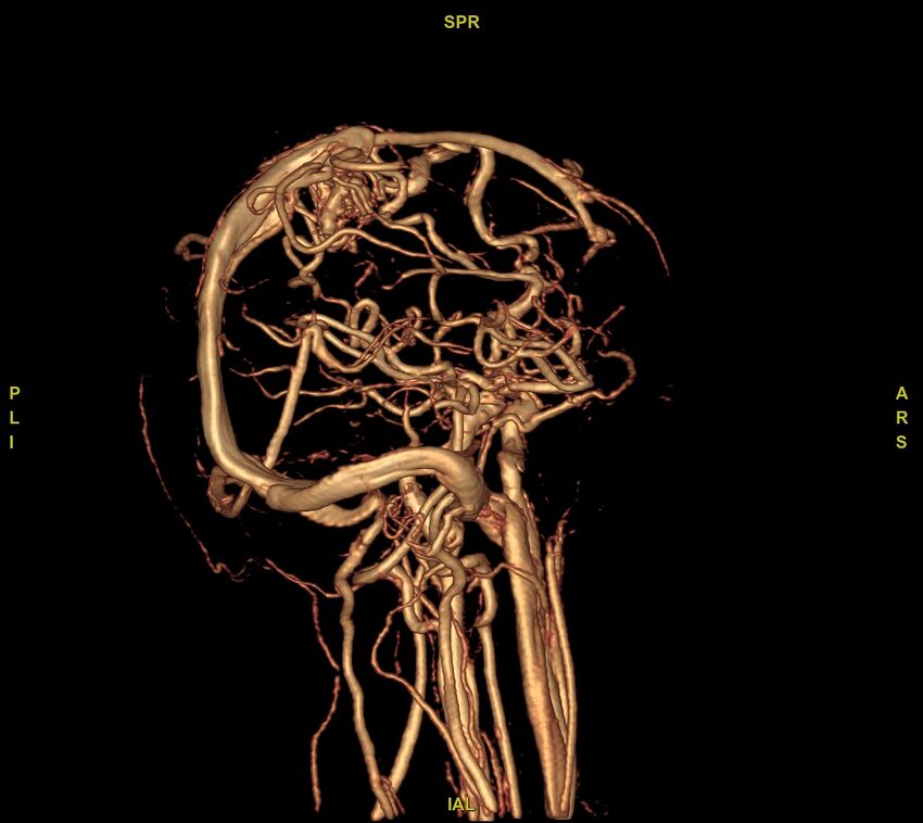 Cerebral arteriovenous malformation (Radiopaedia 61964-70029 VRT 23).jpg