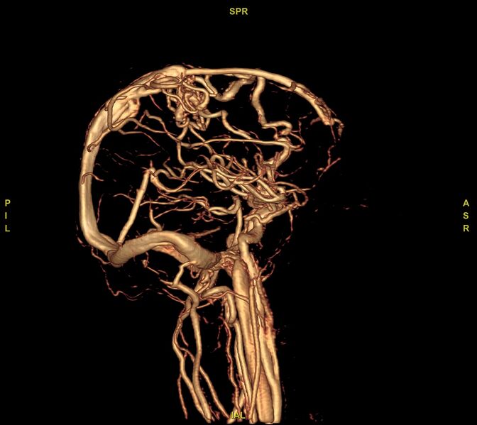 File:Cerebral arteriovenous malformation (Radiopaedia 61964-70029 VRT 27).jpg
