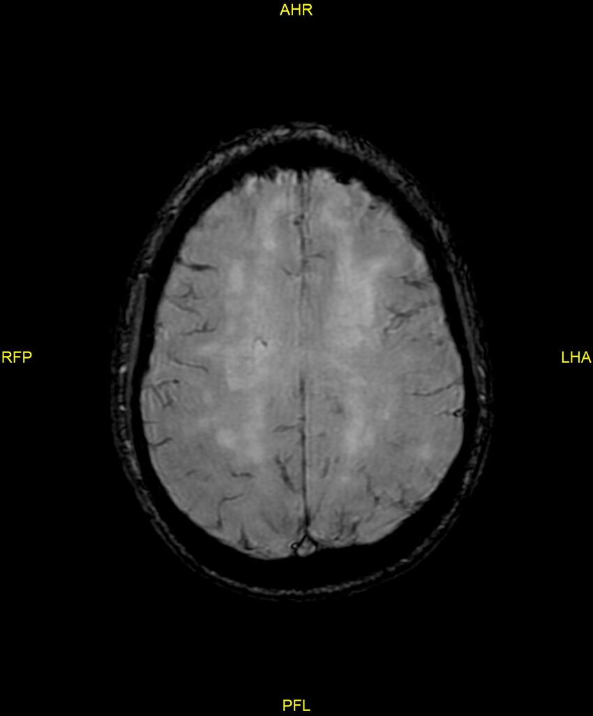 Cerebral autosomal dominant arteriopathy with subcortical infarcts and leukoencephalopathy (CADASIL) (Radiopaedia 86108-102054 Axial SWI 76).jpg