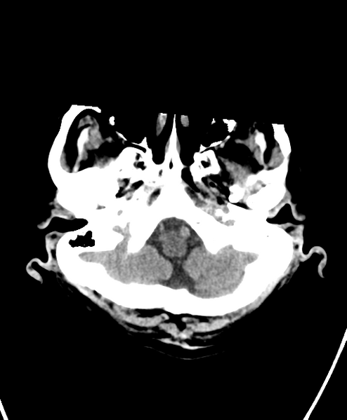 File:Cerebral contusions, subarachnoid hemorrhage and subdural hygromas (Radiopaedia 55399-61828 Axial non-contrast 4).png