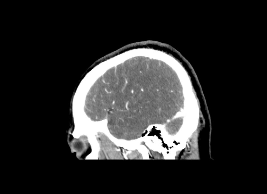 Cerebral edema (Radiopaedia 82519-96661 D 12).jpg