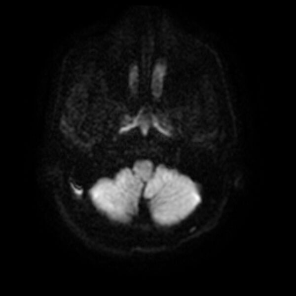 File:Cerebral fat embolism (Radiopaedia 37510-39363 Axial DWI 5).jpg