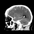 Cerebral hemorrhagic contusions (Radiopaedia 23145-23188 C 30).jpg