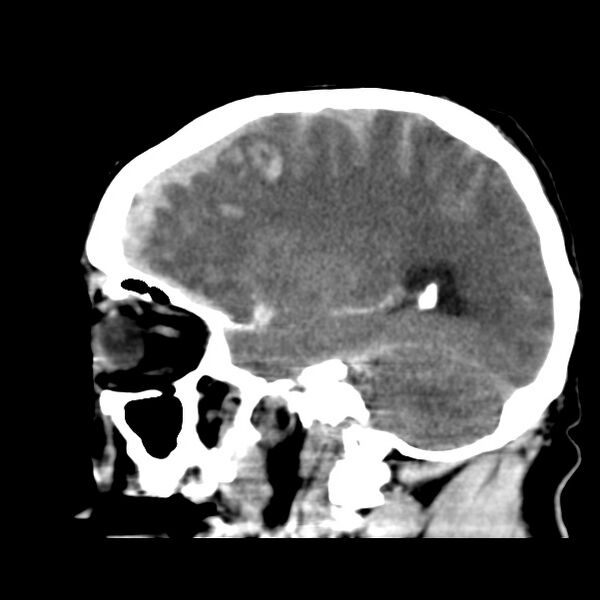 File:Cerebral hemorrhagic contusions (Radiopaedia 23145-23188 C 30).jpg