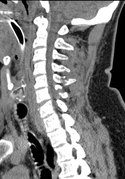 File:Cerebral hemorrhagic contusions and cervical spine fractures (Radiopaedia 32865-33841 G 63).jpg