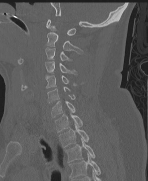 File:Cerebral hemorrhagic contusions and cervical spine fractures (Radiopaedia 32865-33841 Sagittal bone window 58).jpg