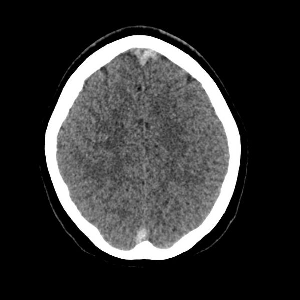 File:Cerebral venous sinus thrombosis (Radiopaedia 59224-66551 Axial non-contrast 34).jpg