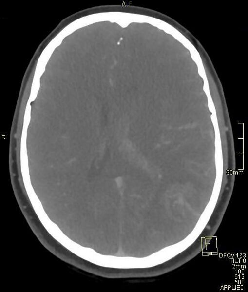 File:Cerebral venous sinus thrombosis (Radiopaedia 91329-108965 Axial venogram 48).jpg