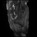 Cervical carcinoma (Radiopaedia 78847-91705 Sagittal T1 fat sat 3).jpg