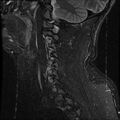 Cervical flexion teardrop fracture with cord hemorrhage (Radiopaedia 32497-33455 Sagittal STIR 15).jpg
