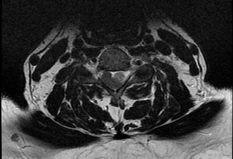 File:Cervical schwannoma (Radiopaedia 72399-82934 Axial T2 13).jpg