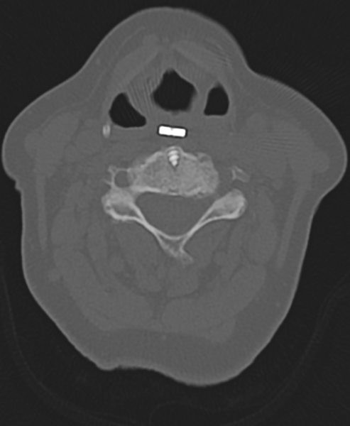 File:Cervical spine ACDF loosening (Radiopaedia 48998-54071 Axial bone window 30).png
