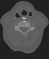 Cervical spine ACDF loosening (Radiopaedia 48998-54071 Axial bone window 30).png