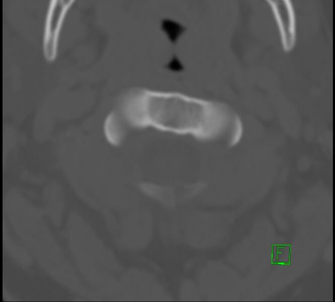 File:Cervical spine fracture - hyperflexion injury (Radiopaedia 66184-75364 Axial bone window 3).jpg