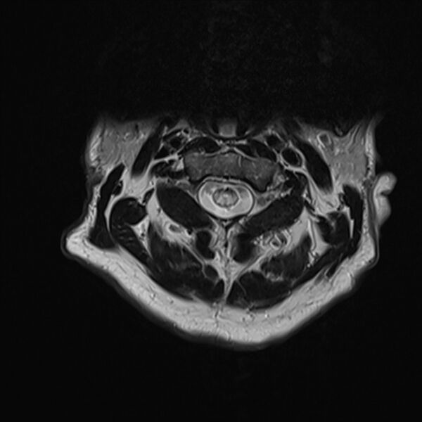 File:Cervical tumor-like myelopathy due to Type V dAVF (Radiopaedia 82461-96604 Axial T2 8).jpg