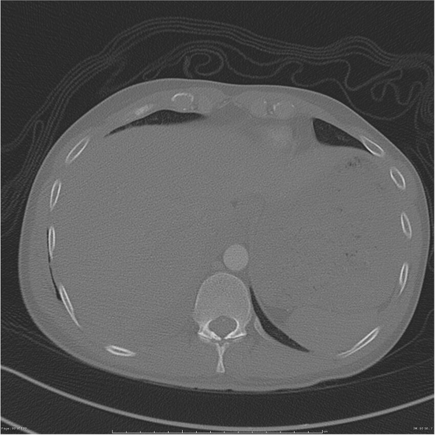 Chest and abdomen multi-trauma (Radiopaedia 26294-26425 bone window 90).jpg