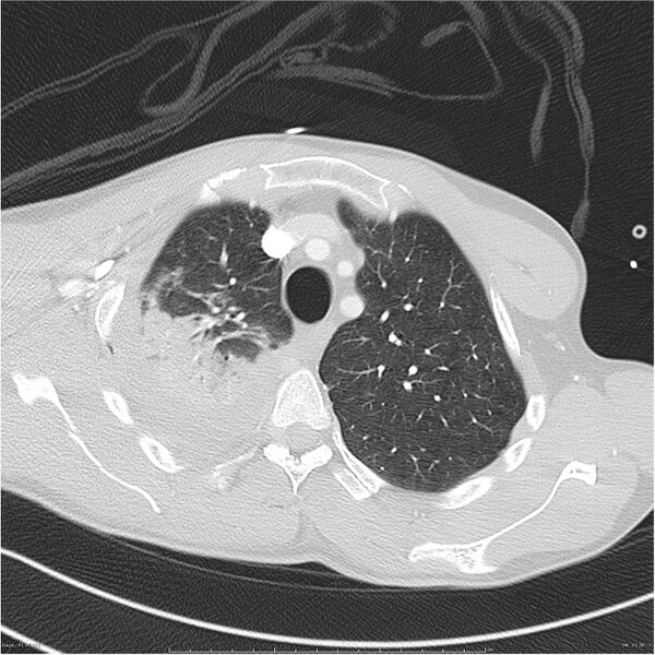 File:Chest and abdomen multi-trauma (Radiopaedia 26294-26425 lung window 31).jpg