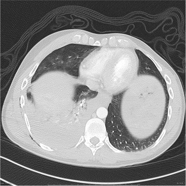 File:Chest and abdomen multi-trauma (Radiopaedia 26294-26425 lung window 79).jpg