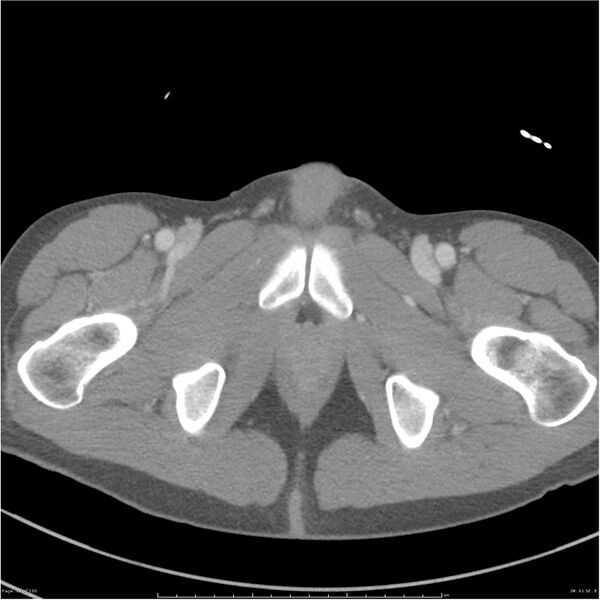 File:Chest and abdomen multi-trauma (Radiopaedia 26294-26426 bone window 91).jpg