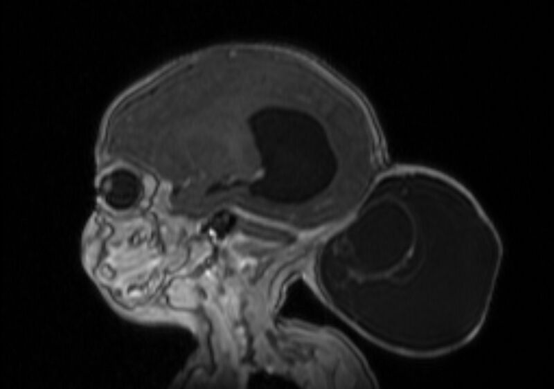 File:Chiari III malformation with occipital encephalocele (Radiopaedia 79446-92559 Sagittal T1 C+ mpr 26).jpg
