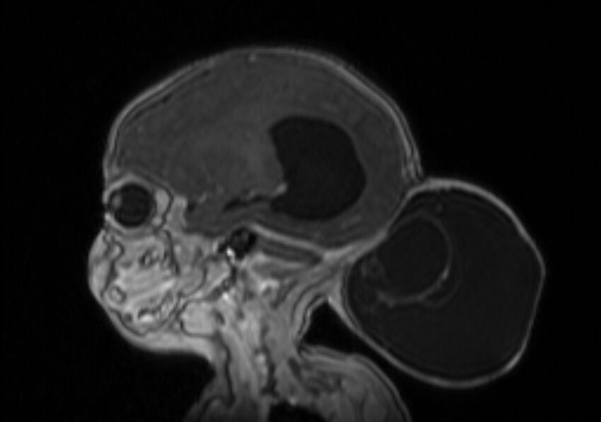 Chiari III malformation with occipital encephalocele (Radiopaedia 79446-92559 Sagittal T1 C+ mpr 26).jpg