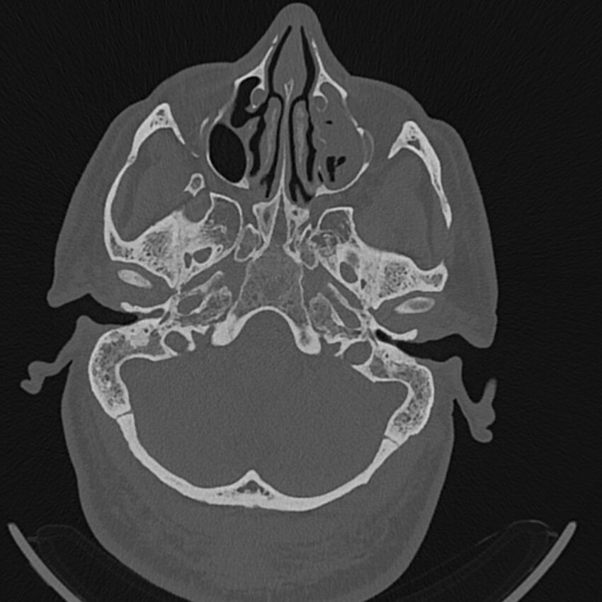 Cholesteatoma (Radiopaedia 68176-77673 Axial bone window 21).jpg