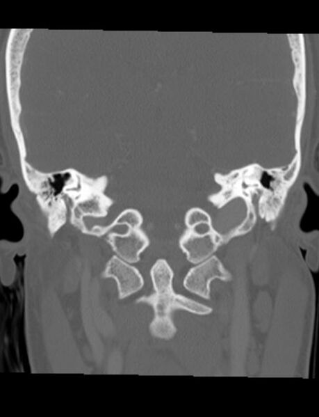 File:Cholesteatoma (pars flaccida) (Radiopaedia 28782-29083 Coronal bone window 10).jpg