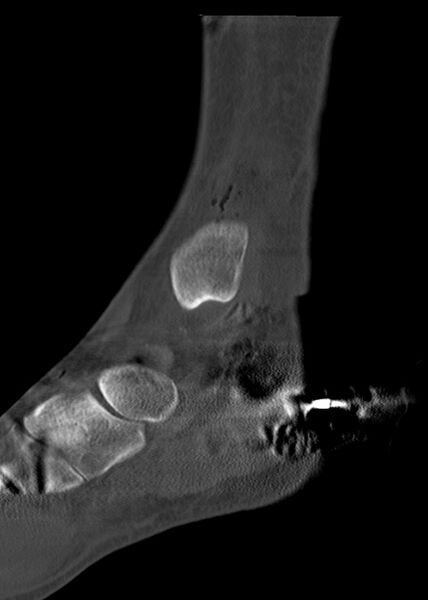 File:Chopart fracture (Radiopaedia 35347-36861 Sagittal bone window 31).jpg