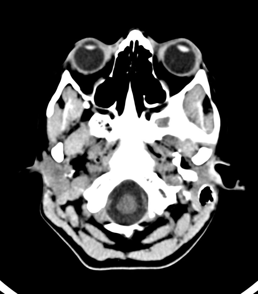 Choroid plexus carcinoma (Radiopaedia 91013-108552 Axial non-contrast 9).jpg
